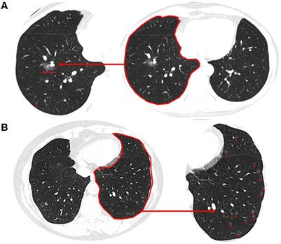 Clinical, radiological, and pathological features of minute pulmonary meningothelial-like nodules and diffuse pulmonary meningotheliomatosis